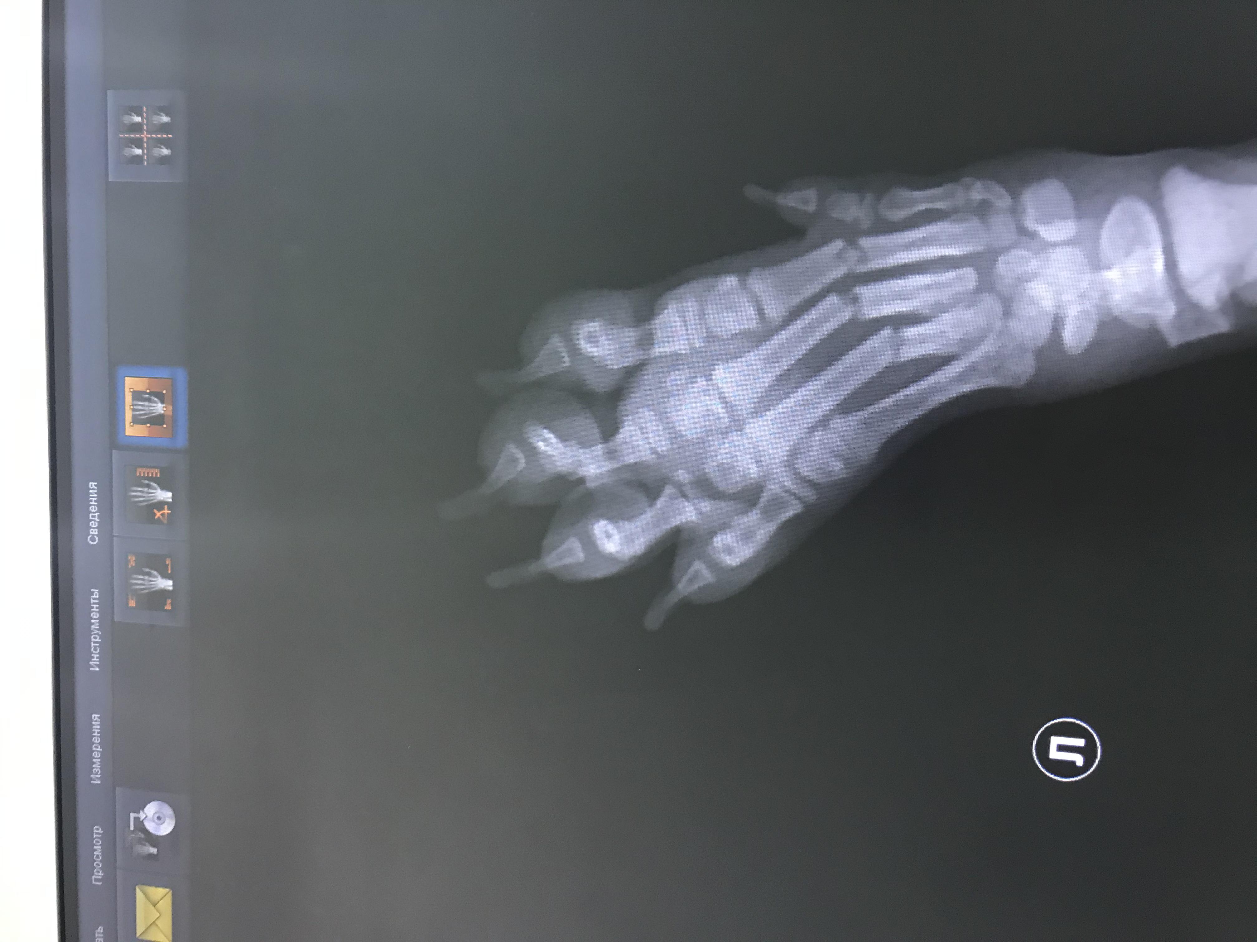Перелом пальцев рентген