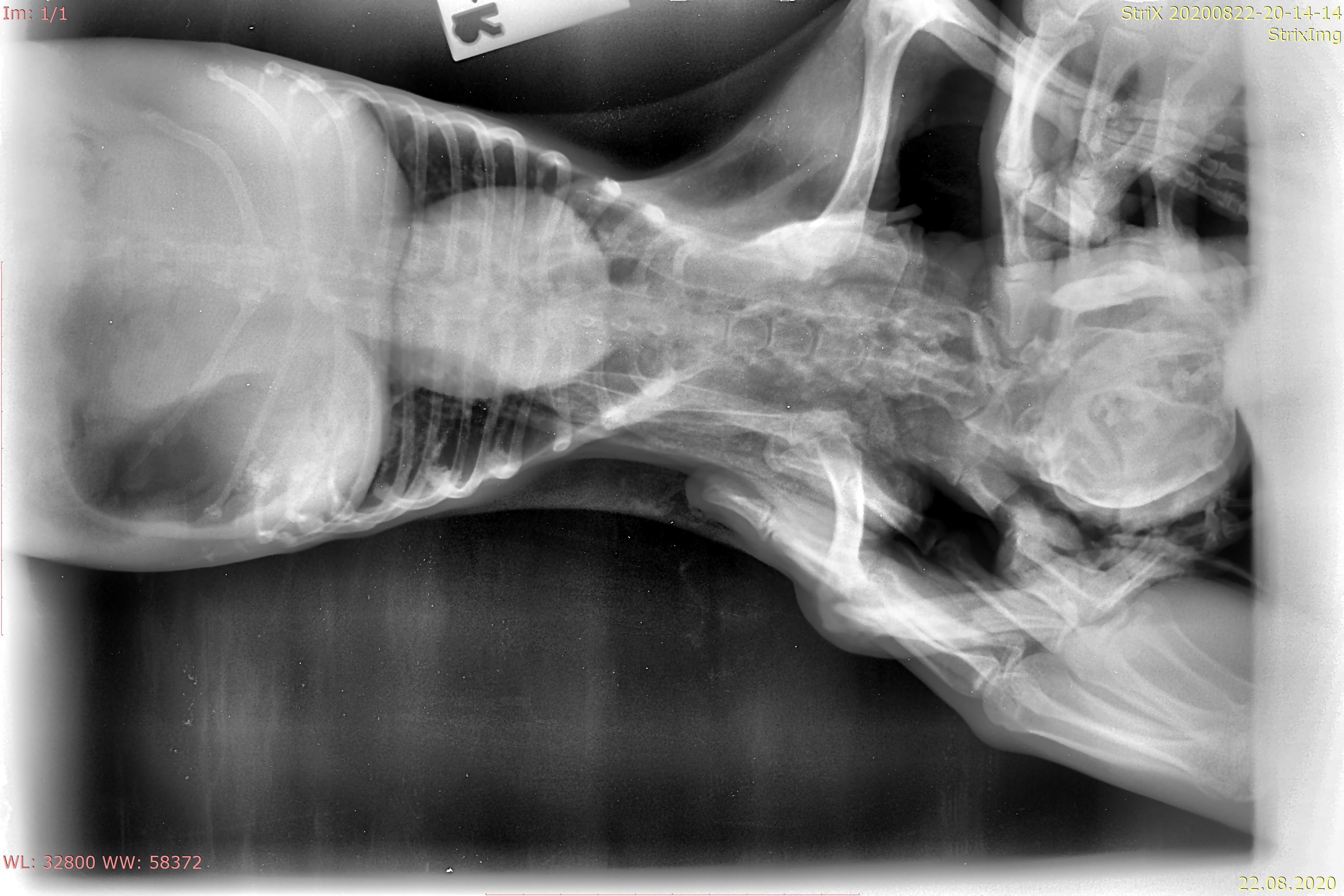 силиконовая грудь на рентгене фото 61